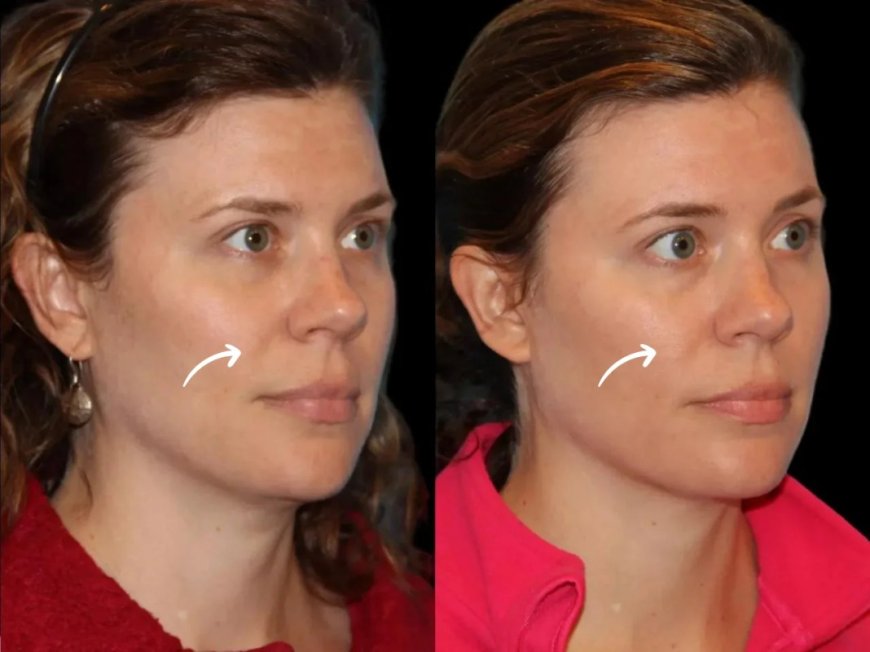 Eco-Friendly Practices in Sculptra Fillers Use at Dubai’s Best Aesthetic Clinic