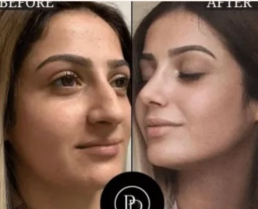 Best Aesthetic Clinic in Dubai for PRP, Fillers, and Botox